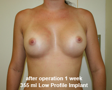 plastic-surgery-breast-augmentation